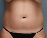 Liposuction Case 53 Before